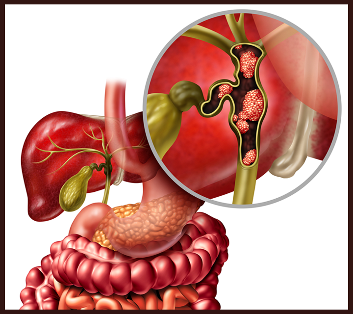 Bile Duct Cancer Bile Duct Cancer